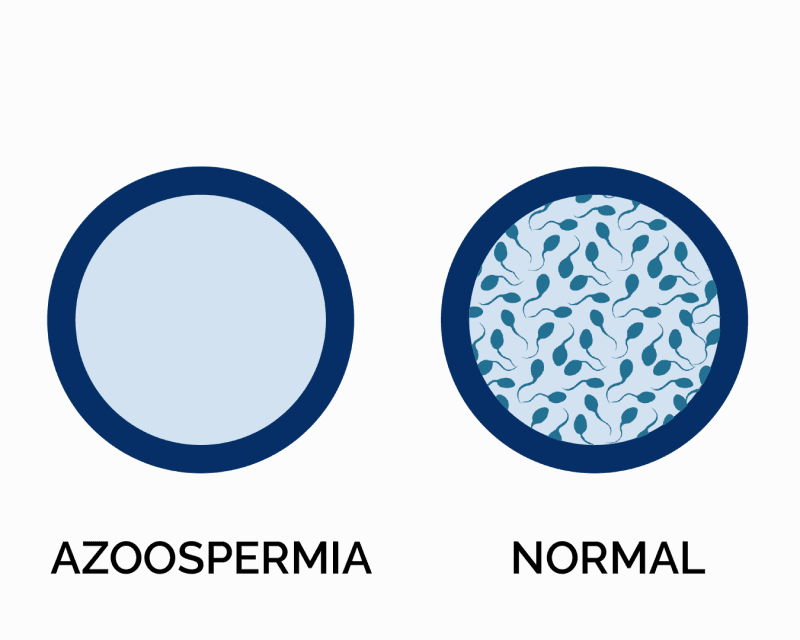 Azoospermia Diagnosis
