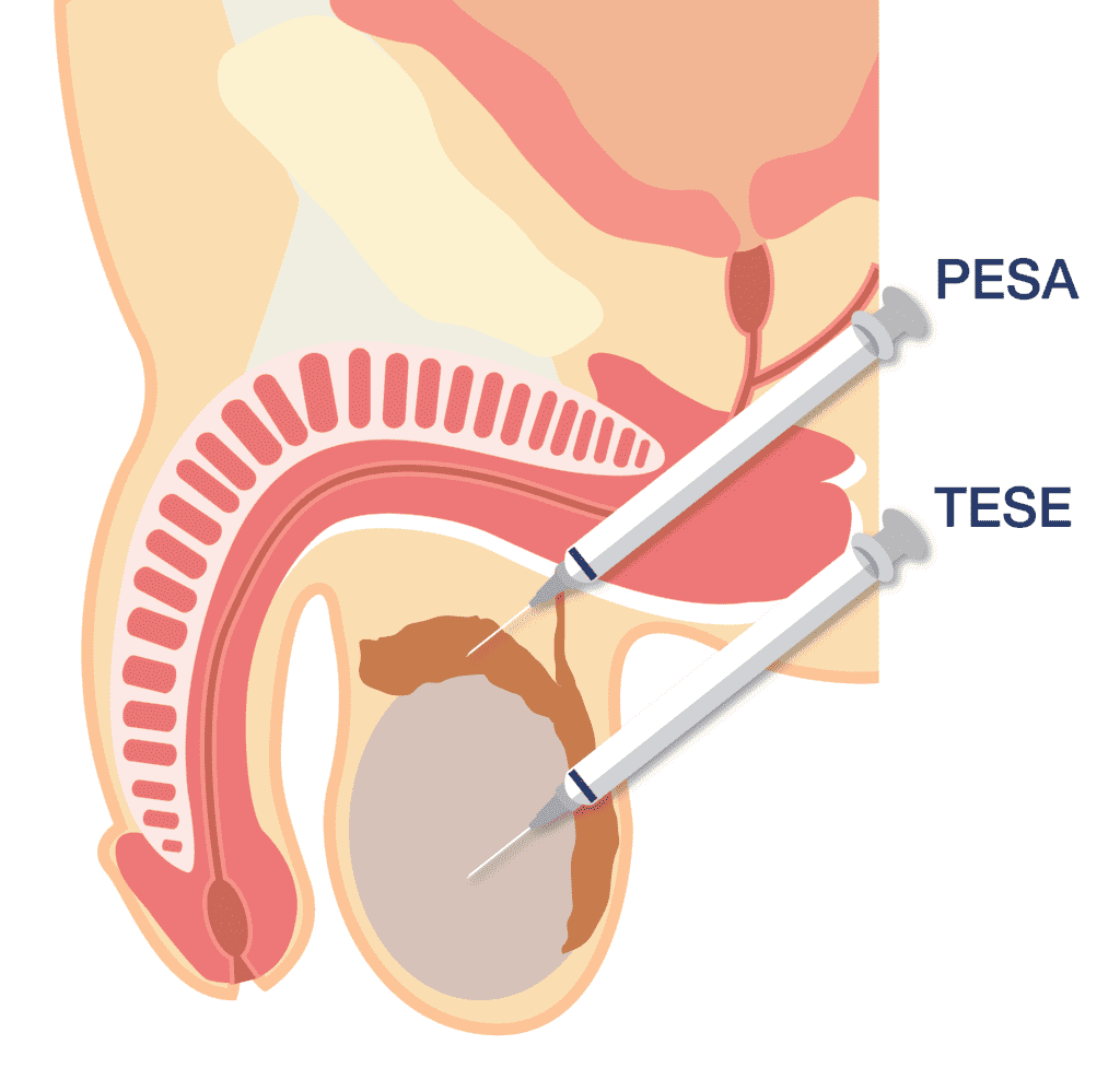 PESA Procedure