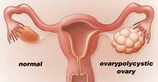 Visual comparison of normal ovary vs PCOS ovary