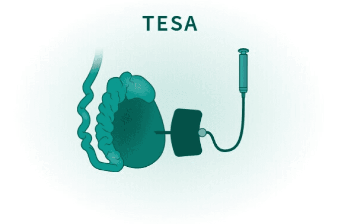 TESA Procedure